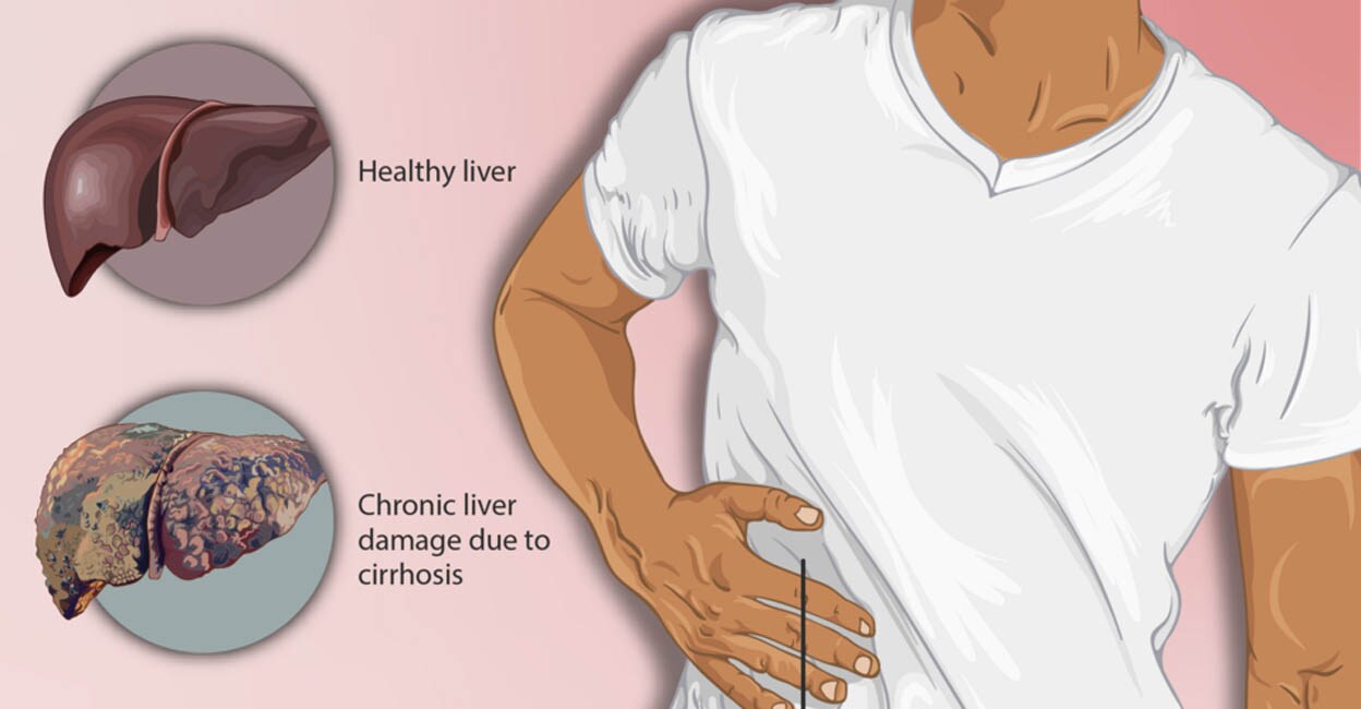 liver-cirrohsis